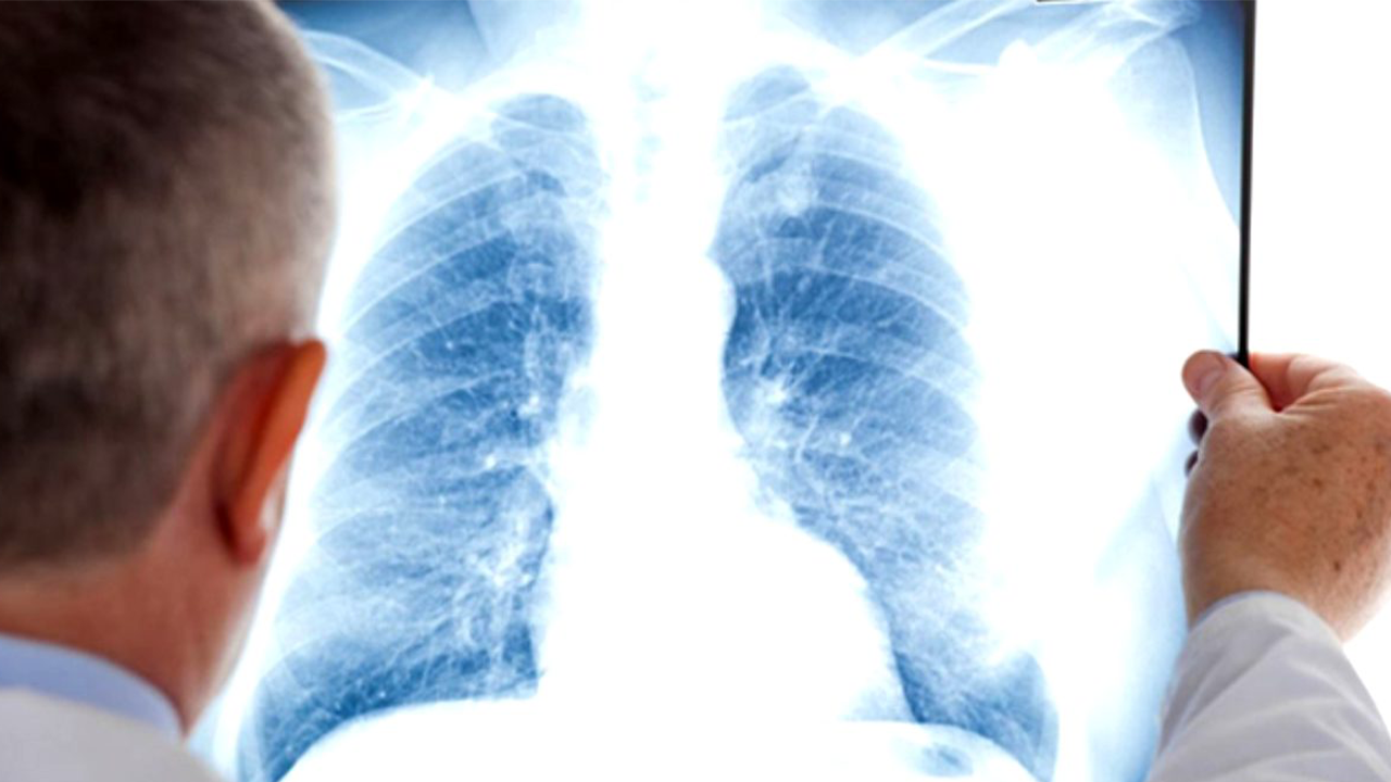 Uzman isim uyardI: Kış aylarında KOAH'a dikkat!