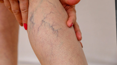 Varis Nedir? Varis Neden Olur?