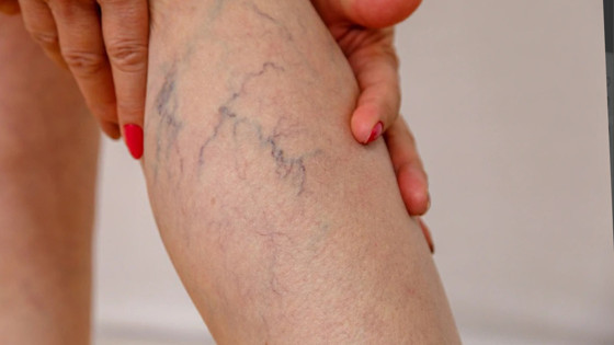 Varis Nedir? Varis Neden Olur?