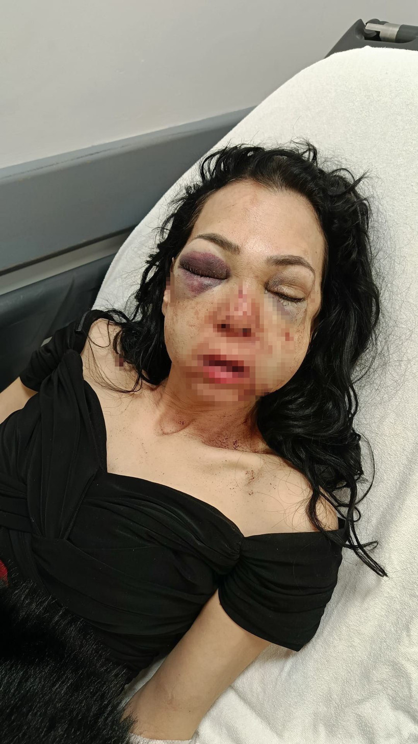 Anne ve oğulu darp eden şahıslardan ilginç savunma: Merdivenlerden düştü! - Resim : 2