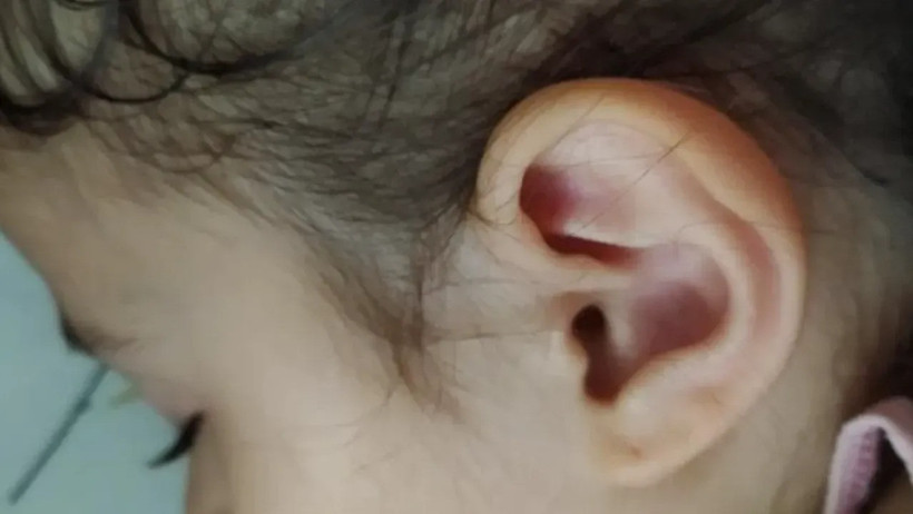 İzmit’te kene paniği… 3 yaşındaki çocuğa parkta kene yapıştı - Resim : 1