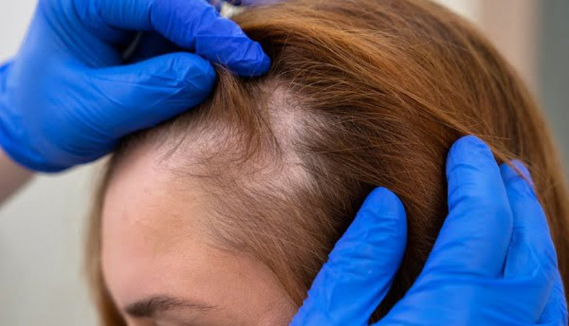 Saç Dökülmesini Önleyen Yeni Teknolojiler - Resim : 1