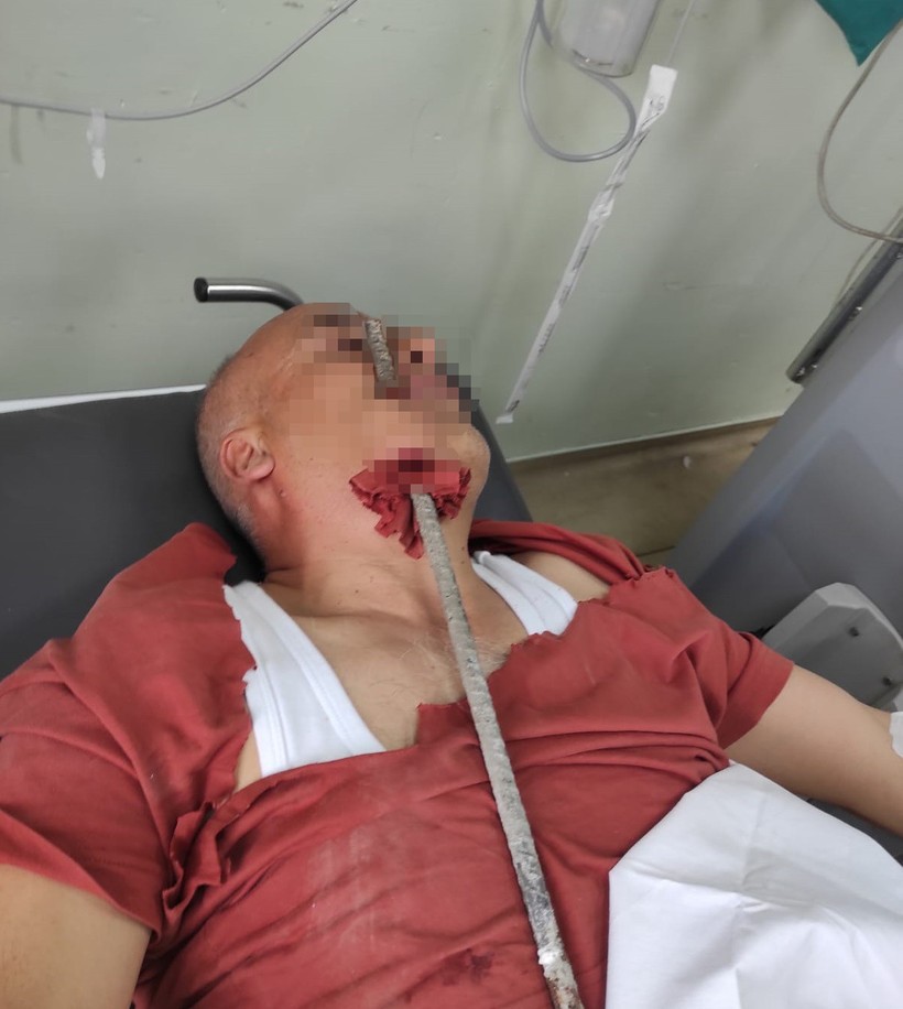Feci kaza! İnşaat işçisinin yüzüne demir saplandı - Resim : 1